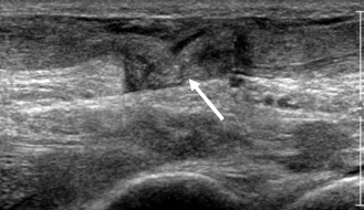 Echographie haute-fréquences