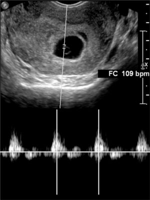 Echographie et Doppler