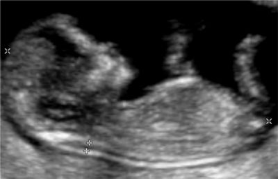 Echographie obstétricale