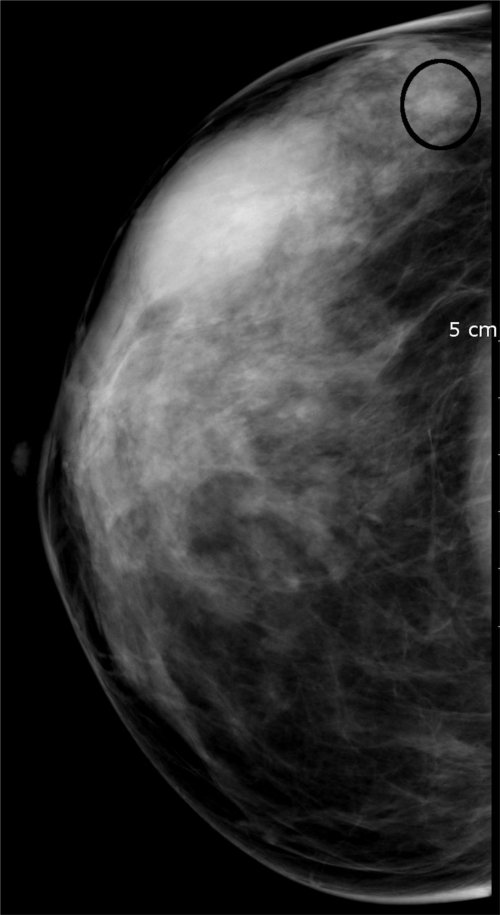 Détection assistée par ordinateur (CAD)