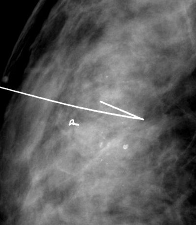 Mammotome biopsies du sein
