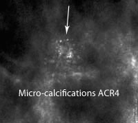 Dépistage du Cancer du Sein